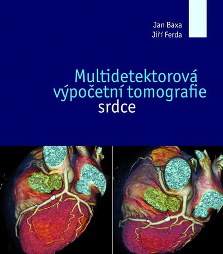 Multidetektorová výpočetní tomografie srdce - Jan Baxa,Jiří Ferda