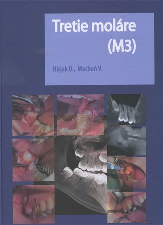 Tretie moláre (M3) - Vladimír Machoň,Dušan Hirjak