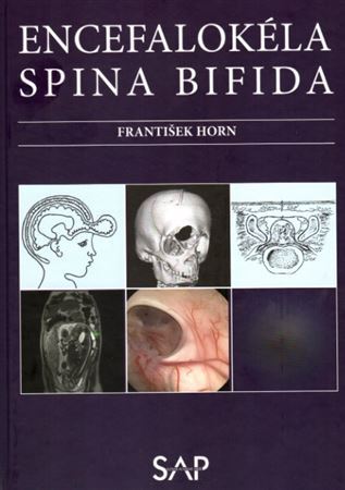 Encefalokéla spina bifida - František Horn