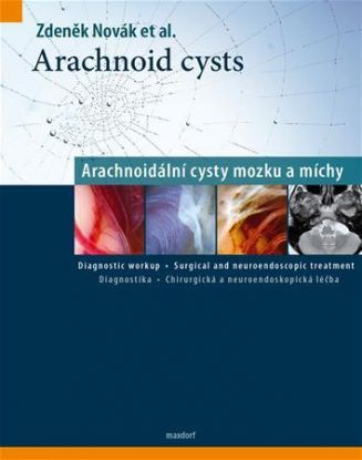 Arachnoid cysts