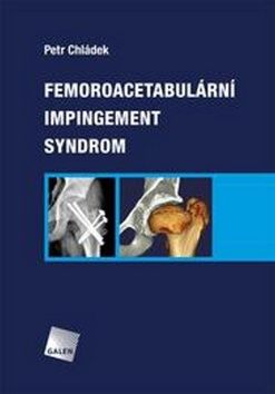 Femoroacetabulární impingement syndrom